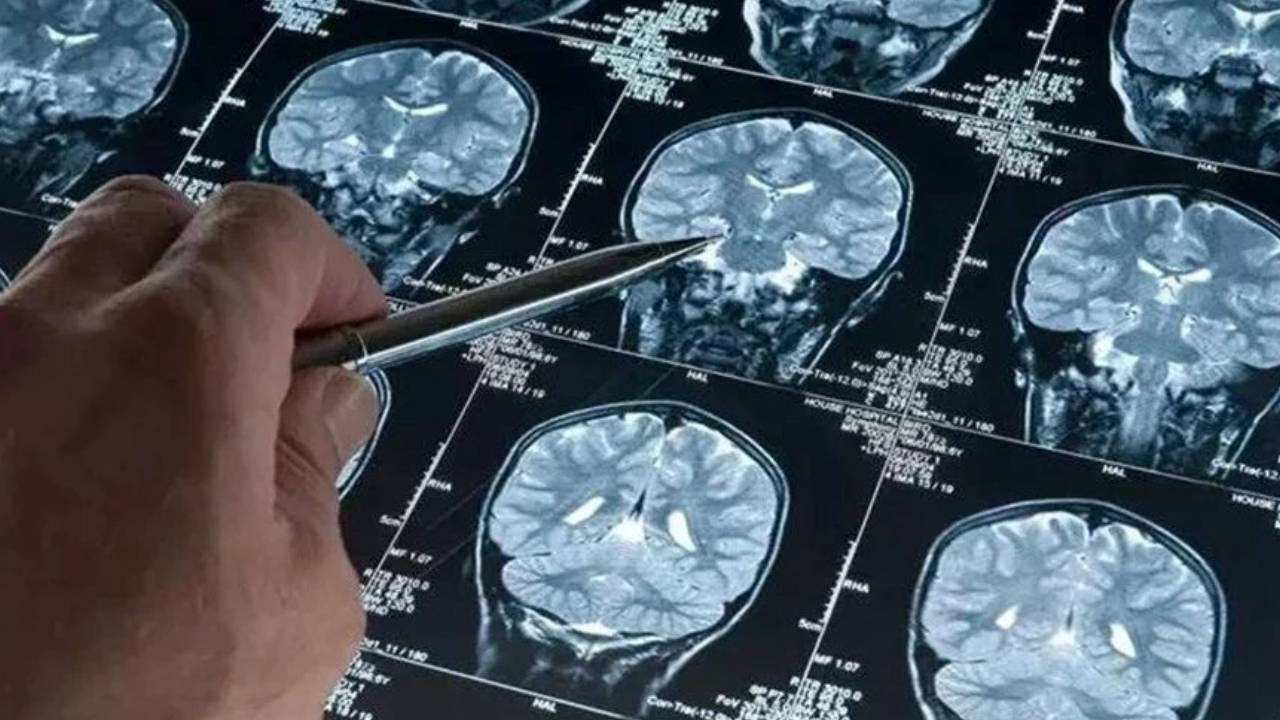 Alzheimer teşhisinde kan testi umudu